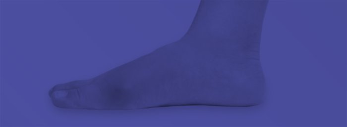 Articulação do pé inflamada por crise de gota